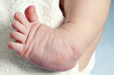 Key Facts About Clubfoot